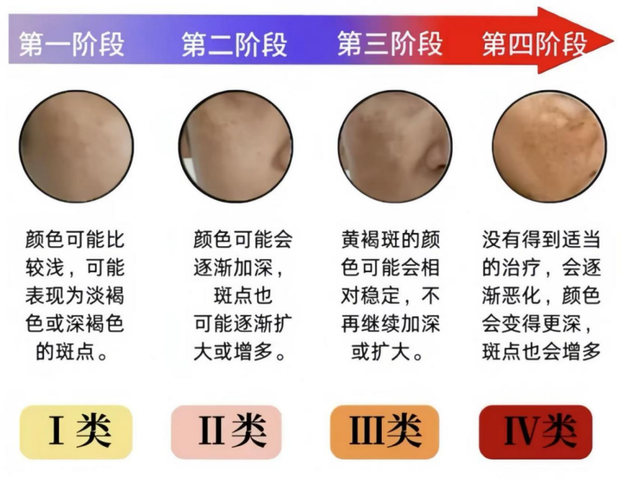 image.png 黄褐斑总反复?联合方案稳住皮肤屏障:经皮水分流失值与角质层含水量的检测